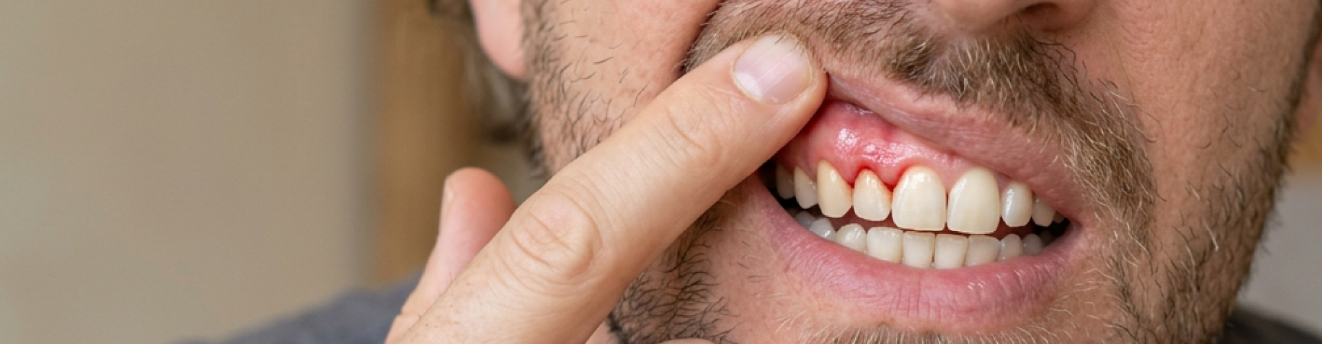 Man lifting his upper lip to show gums.